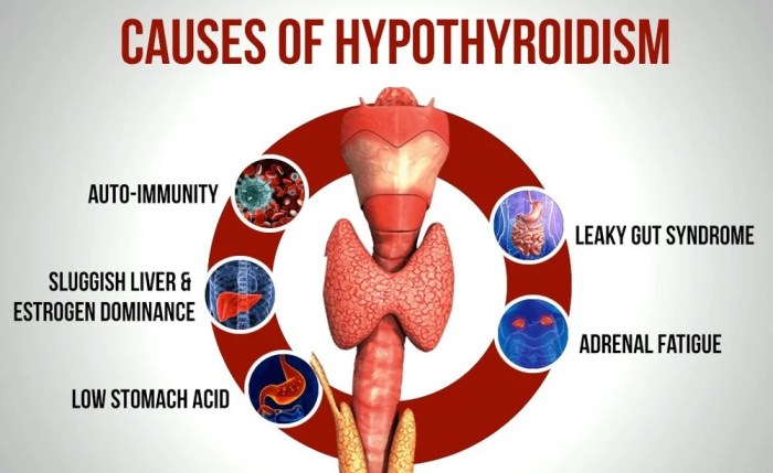 Which of the following accompanies hashimoto's thyroiditis