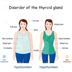 Which of the following accompanies hashimoto's thyroiditis